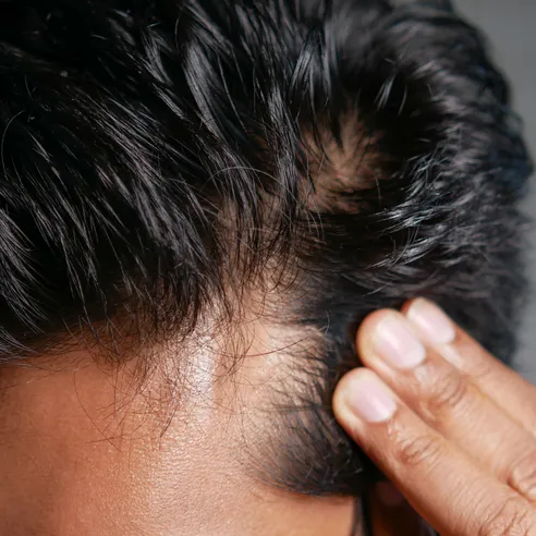 Close-up of a thinning hairline